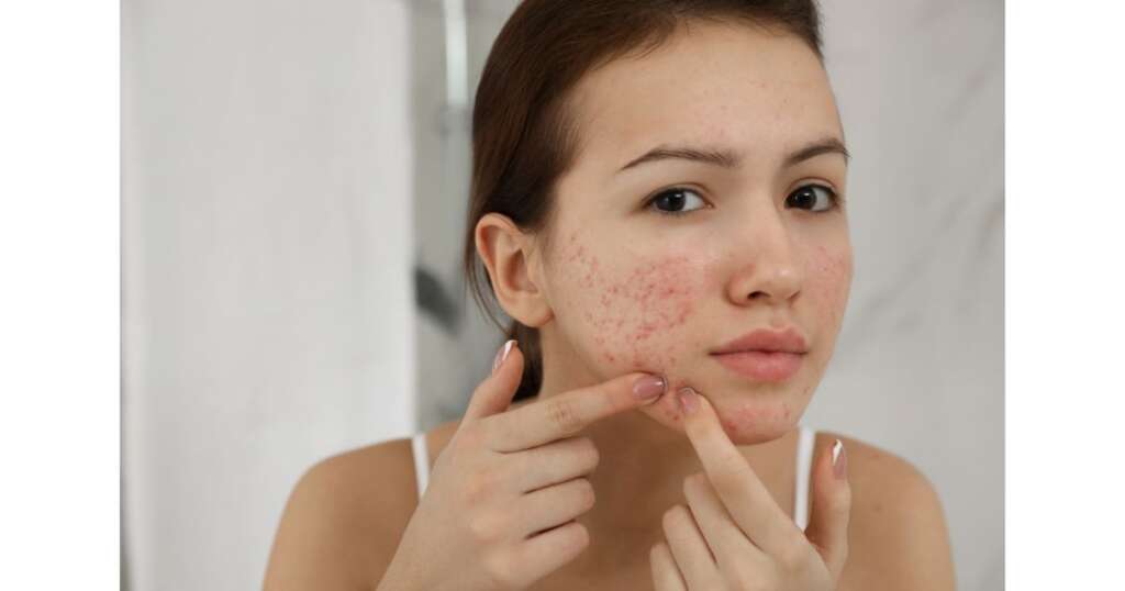 Whey Protein acne saiba como evitar espinhas ao consumir o suplemento