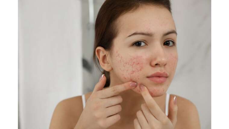 Whey Protein acne: saiba como evitar espinhas ao consumir o suplemento