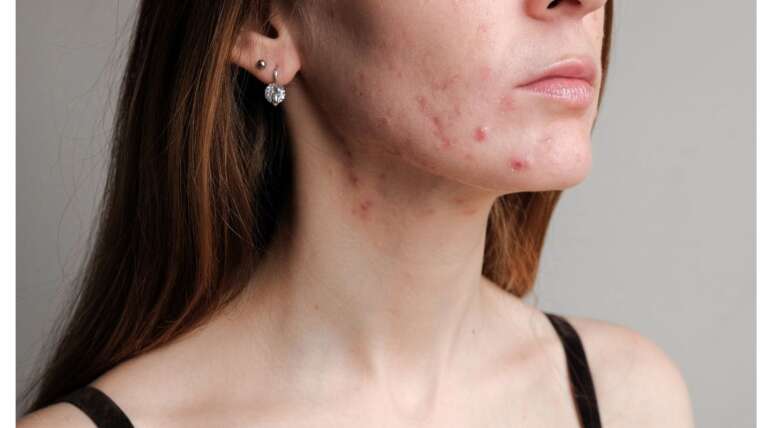 Whey Protein causa acne? entenda qual é a relação