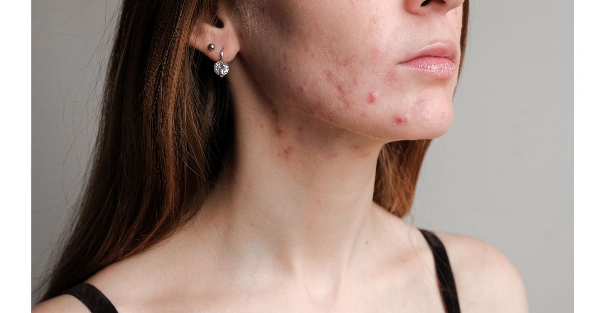 Whey Protein causa acne